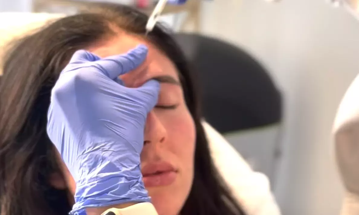 Flaunt Flawless Skin: 50 Units of Dysport at Wild and Beautiful 