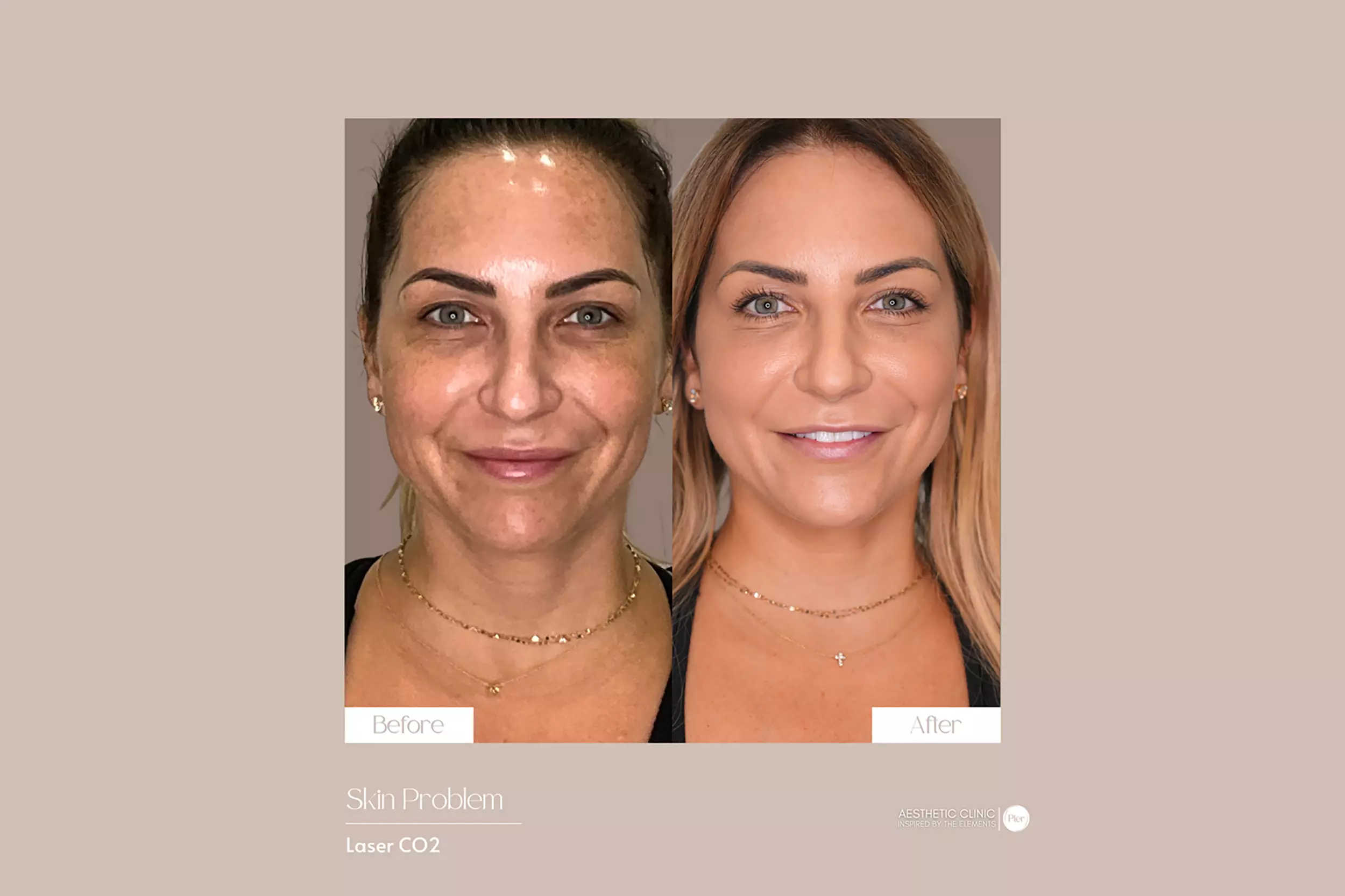 Miami Botox Miami, FL Deals, Coupons & Discounts | Groupon
