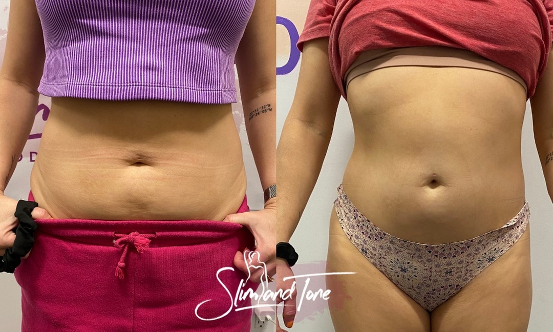 Electromagnetic Fat Reduction for One or Two Areas