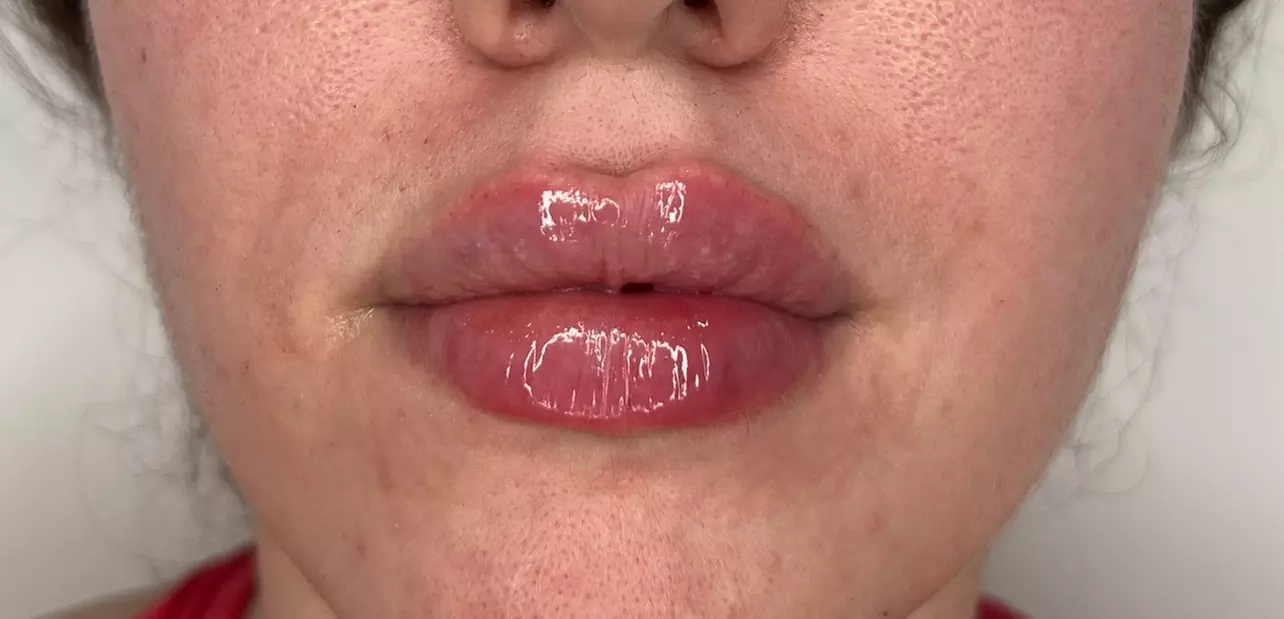 Plump & Hydrate Lips with Restylane Kysse Lip Filler Treatment