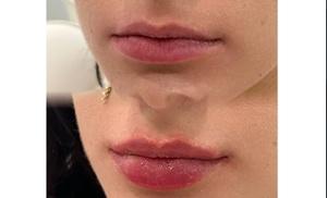 Enhance Your Look with Revanesse Versa+ and Lip Fillers