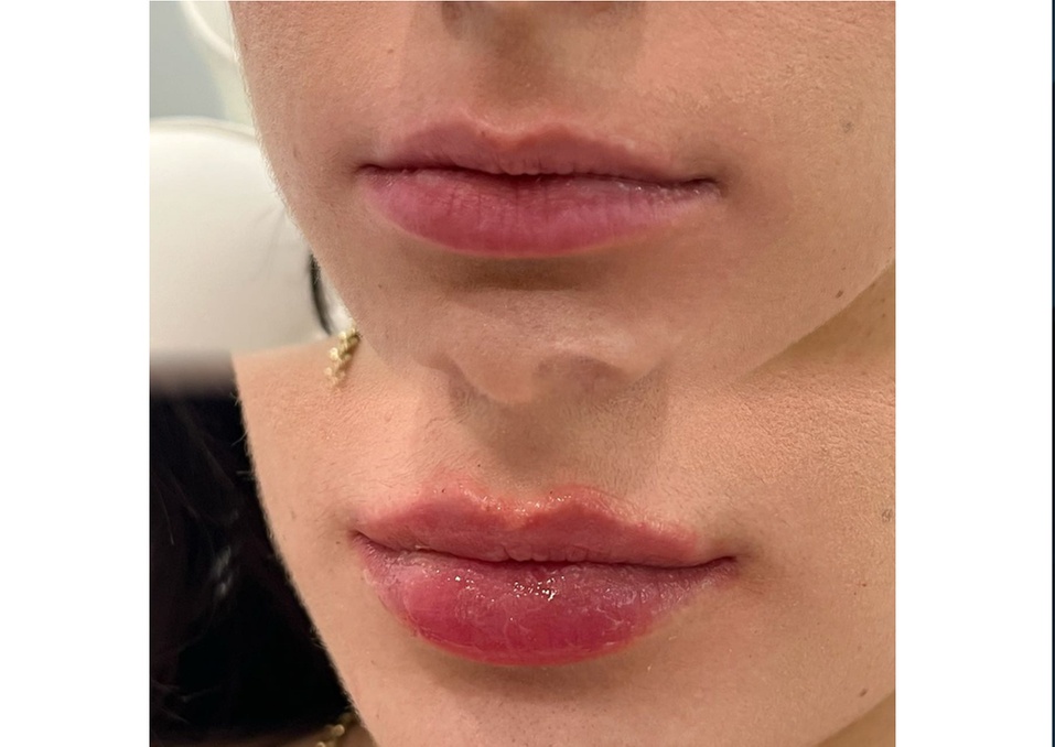 Achieve a Natural Look with Dermal Filler Injections