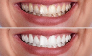 Teeth Whitening