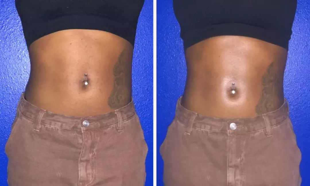 Up to 32% Off on Cavitation at Empress Body Beauty - Primary Image