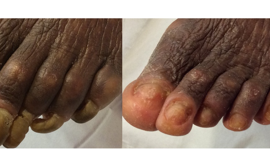 Image 3: Expert Podiatry Consultation for Fungal Toenail Relief @ Raymond Nash