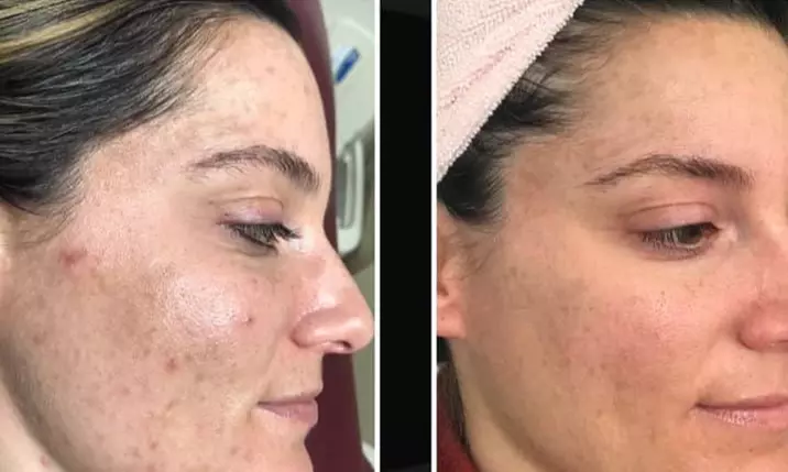 Up to 66% Off on Facial - Chemical Peel at UK Aesthetics Lounge