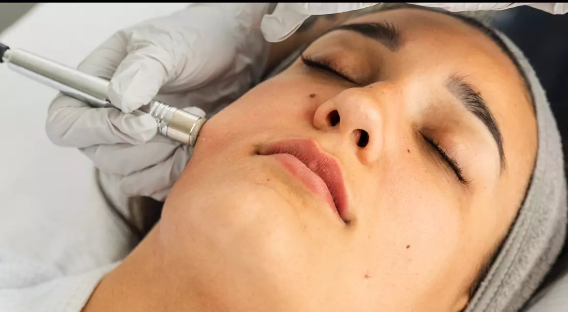 Glow Facial Treatment, Radiofrequency Facial Treatment or Microneedling Facial Treatment (Up to51% Off) - Primary Image