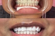 Up to 15% Off on Teeth Whitening at Pearl Glow Smiles - Second Medium