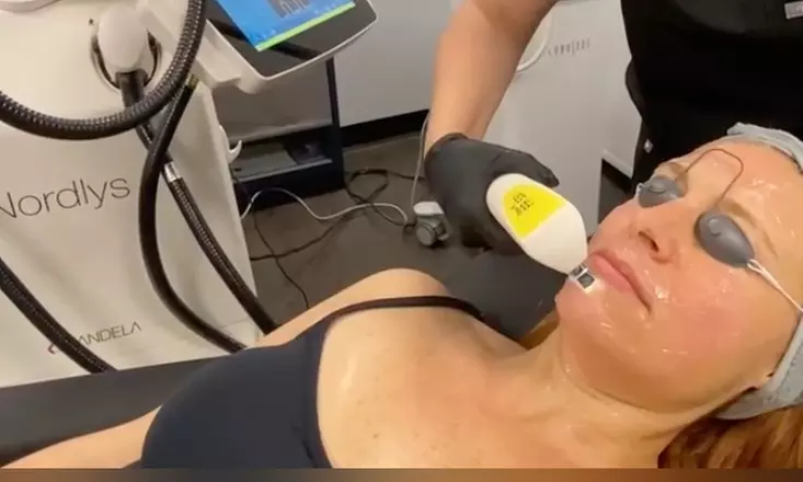 Up to 35% Off on Laser Skin Resurfacing - Branded at Vitality Medical Aesthetics, LLC