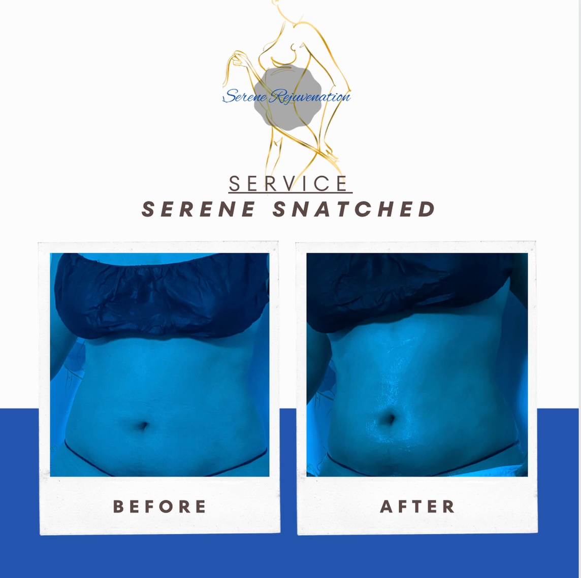 Up to 35% Off on Cavitation at Serene Rejuvenation
