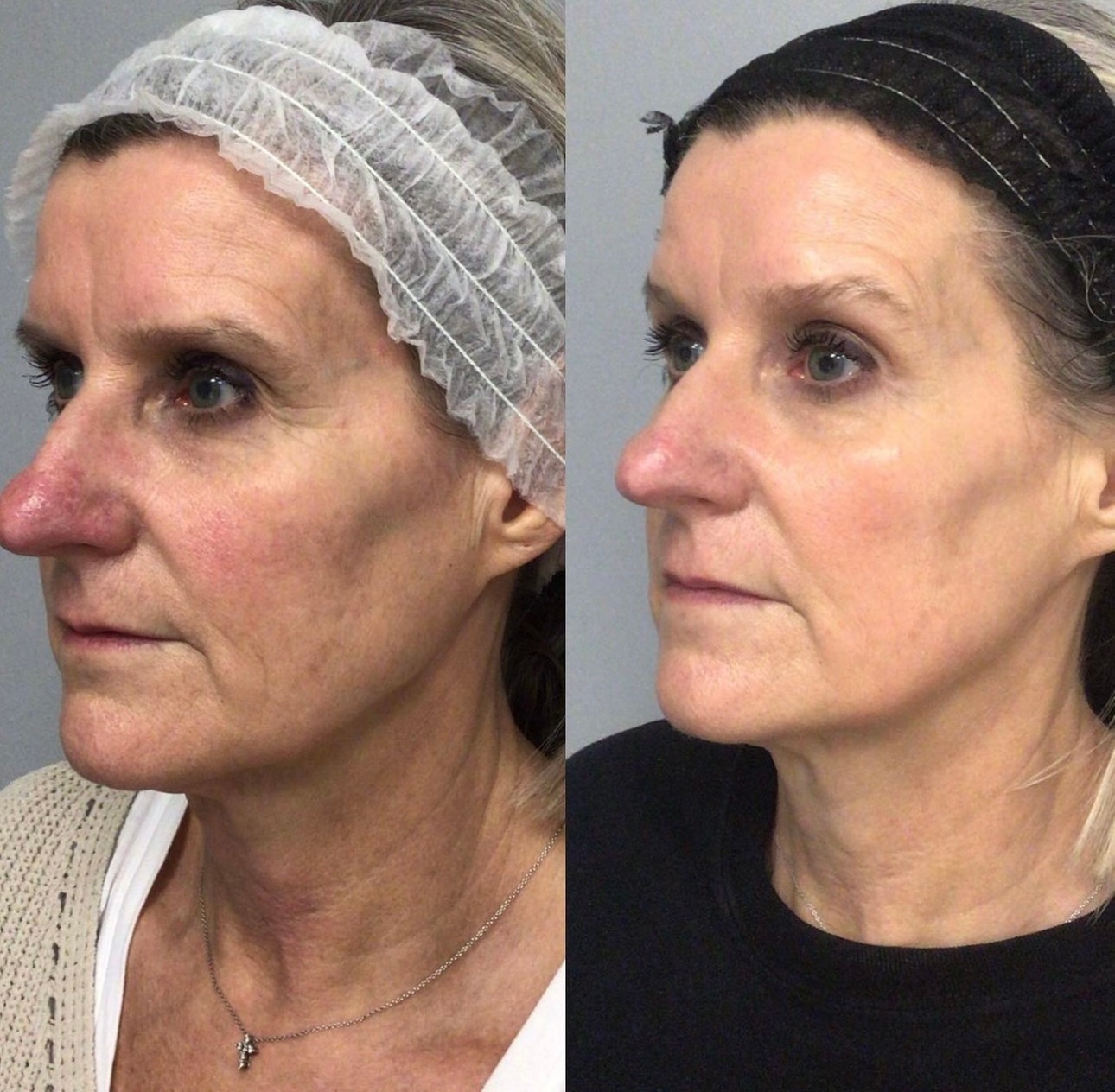 Up to 64% Off on Facial - Microcurrent at Facial Fitness LLC