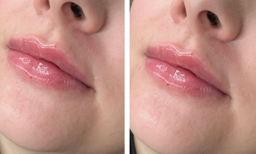 Image 3: Stunning Lips Awaits with 0.5 or 1 ml of Russian Lips Dermal Filler