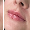 Image 3: Stunning Lips Awaits with 0.5 or 1 ml of Russian Lips Dermal Filler