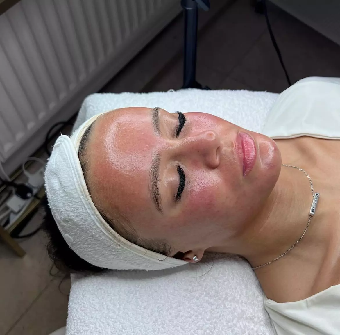 Up to 37% Off on Micro-Needling at Revive Esthetic