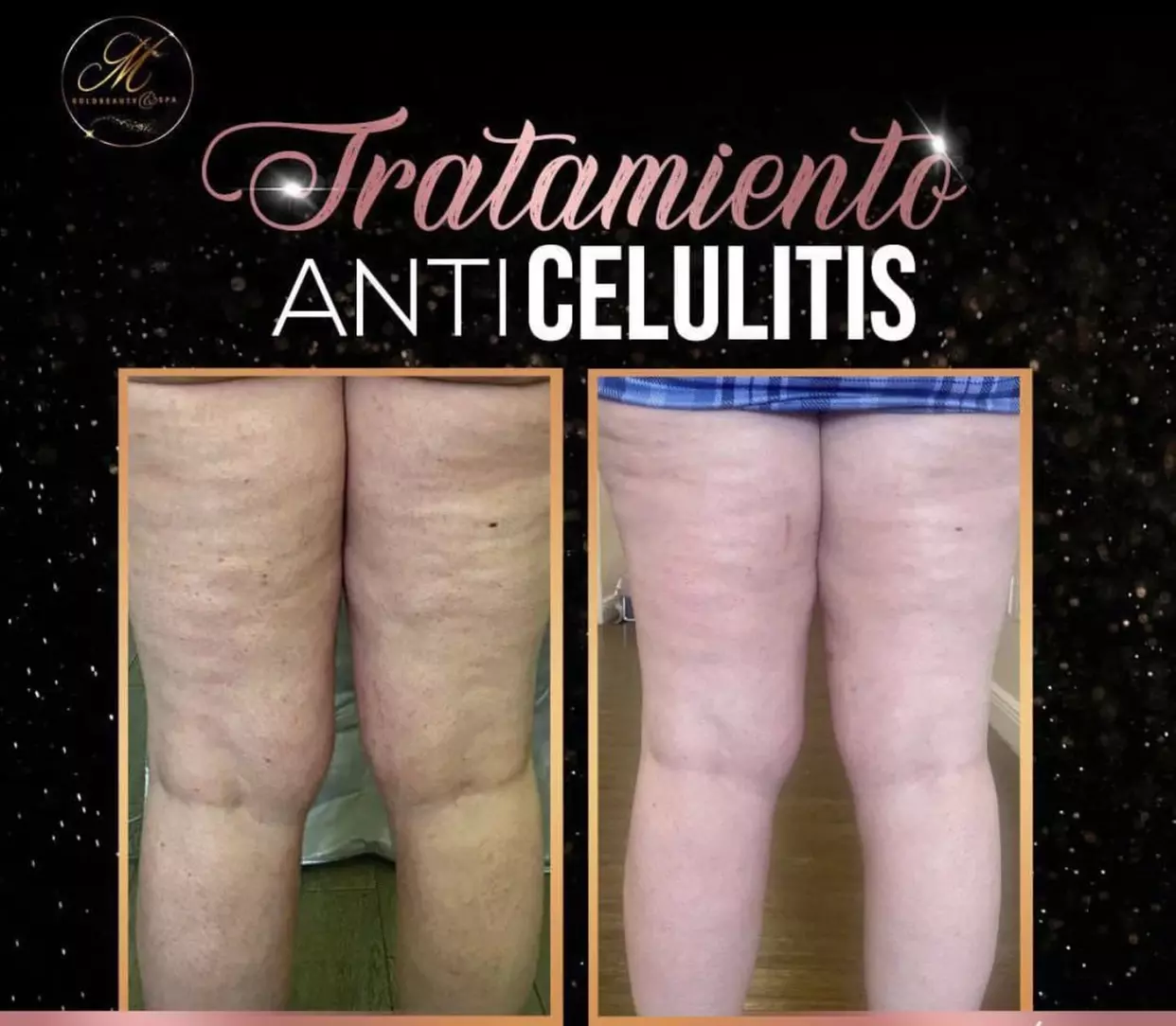 Up to 30% Off on Ultrasonic Fat Reduction at M Gold Beauty Spa