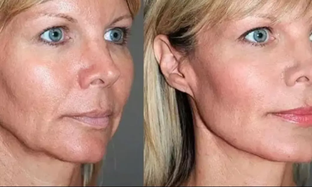 Up to 10% Off on Facelift - Thread Lift at Lux Mami Med Spa - Primary Image