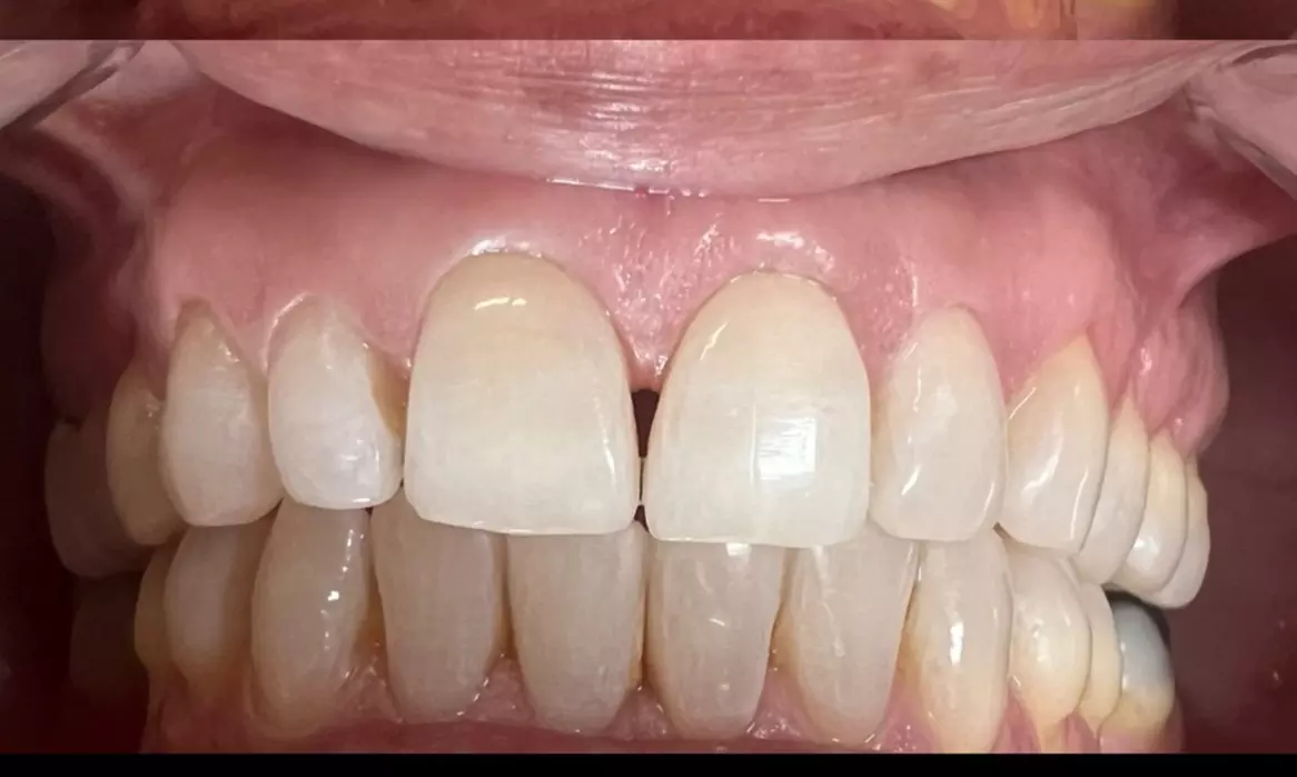 Up to 44% Off on Teeth Whitening at Vivid smiles - Second Medium