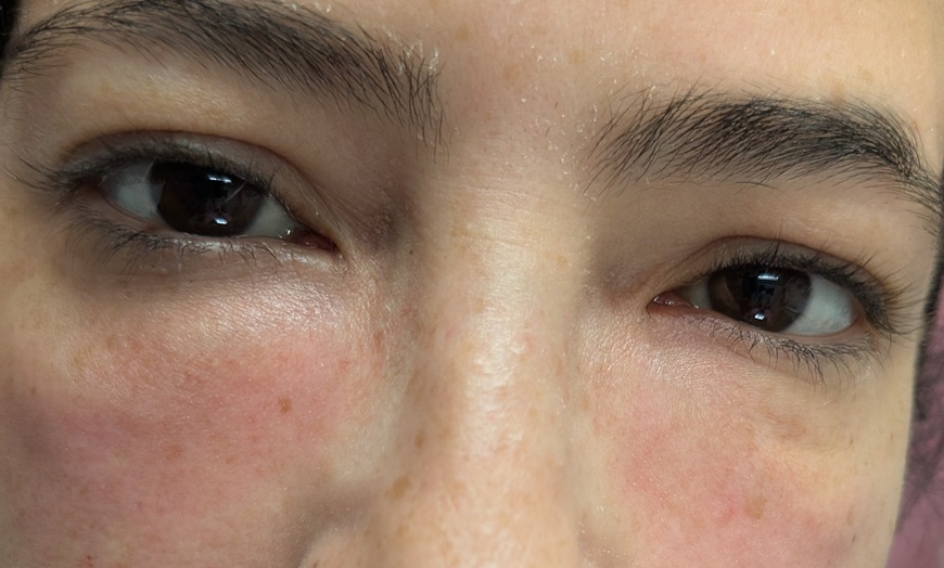 Image 4: Target Dark Circles & Puffiness: PRF Under-Eye Therapy (1/ 3 Sessions)