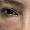 Image 4: Target Dark Circles & Puffiness: PRF Under-Eye Therapy (1/ 3 Sessions)