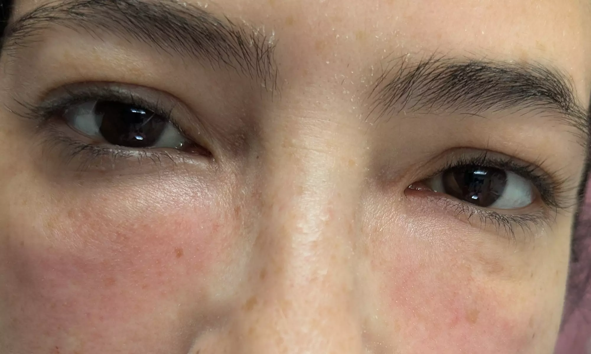 Target Dark Circles & Puffiness: PRF Under-Eye Therapy (1/ 3 Sessions)