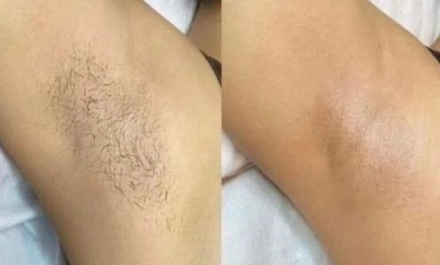 Image 2: Six Laser Hair Removal Sessions For Small to Extra Large Areas