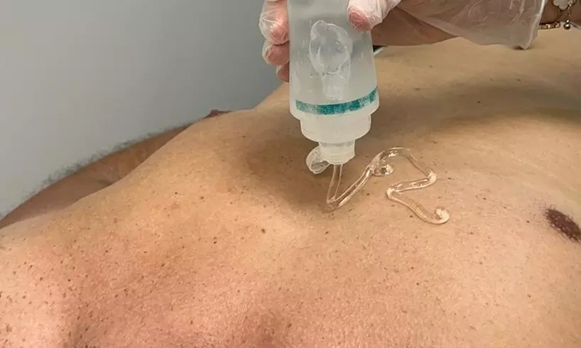Six Laser Hair-Removal Sessions on Various Areas