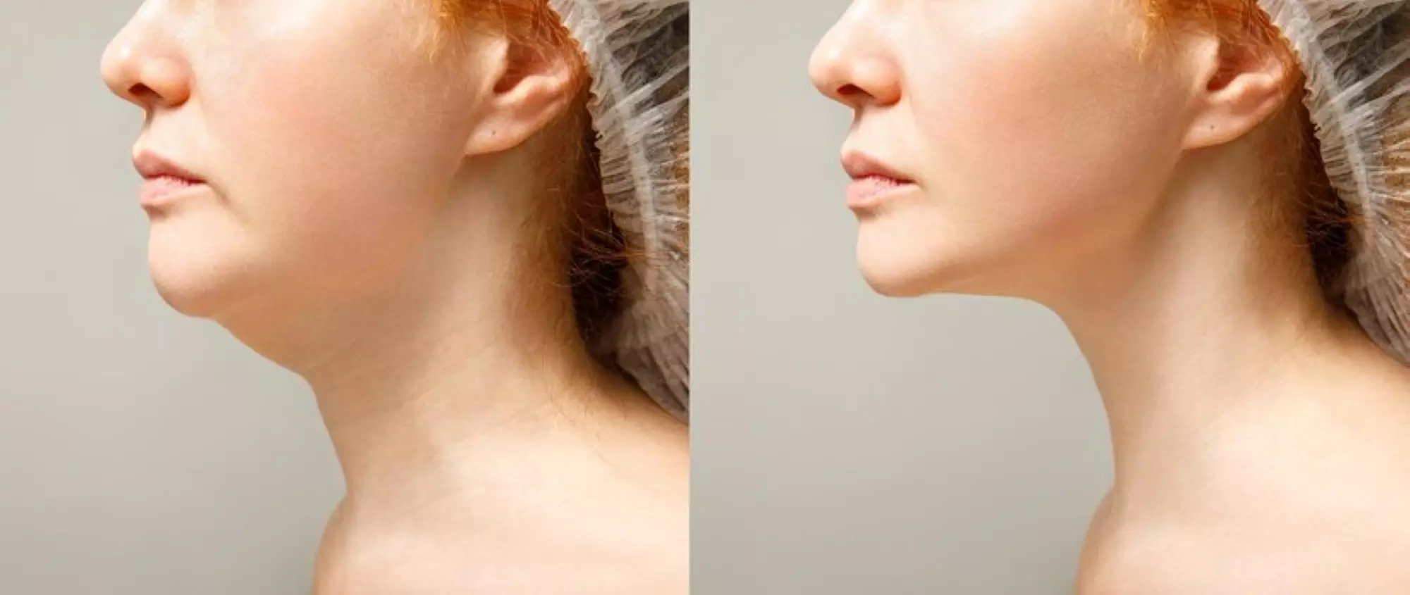 Lumex offers Kybella treatment with options for one or two vials, reducing submental fat up to 35% effectively - Primary Image