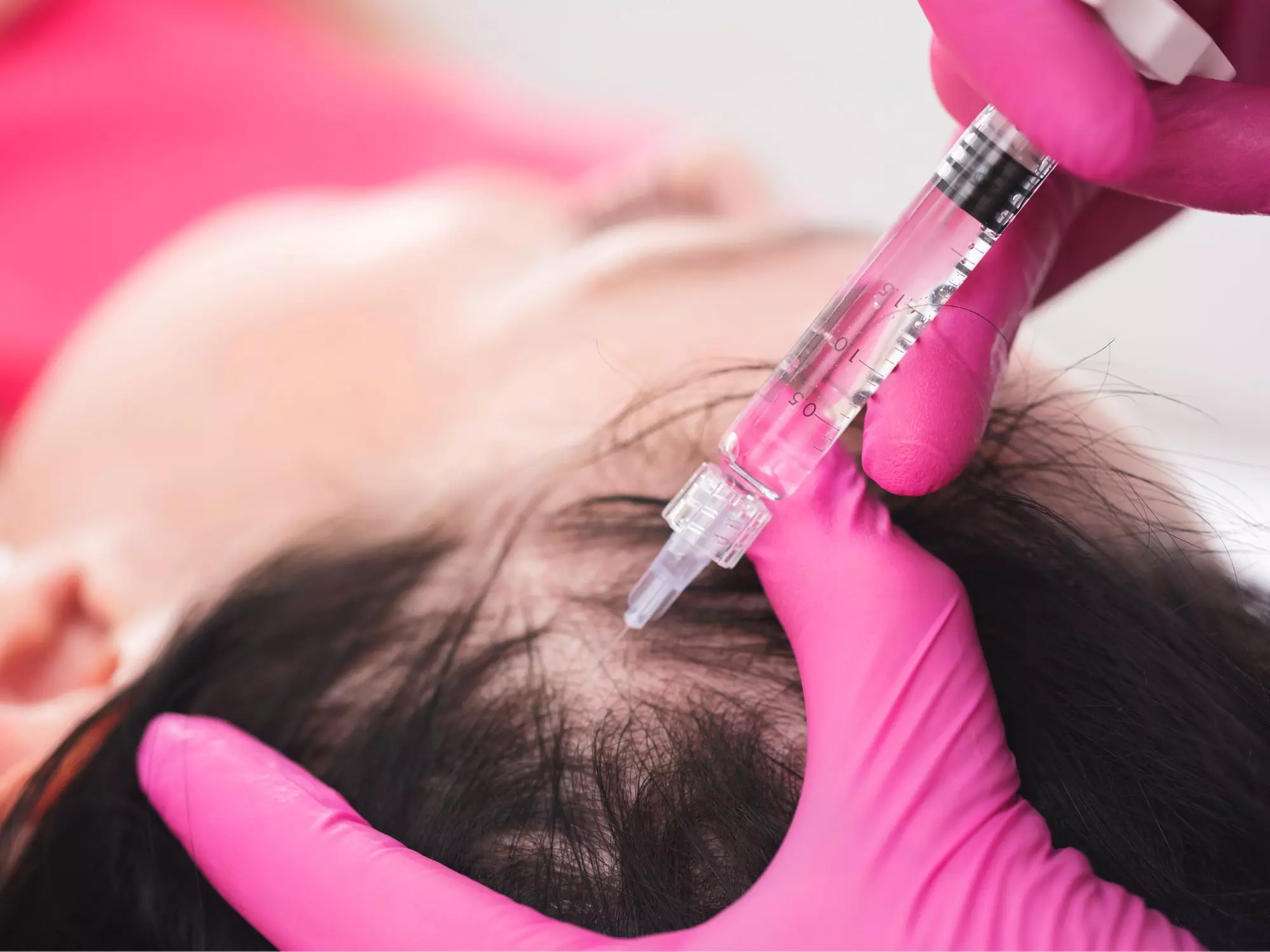 Up to 67% Off on PRP Platelet Rich Plasma treatment