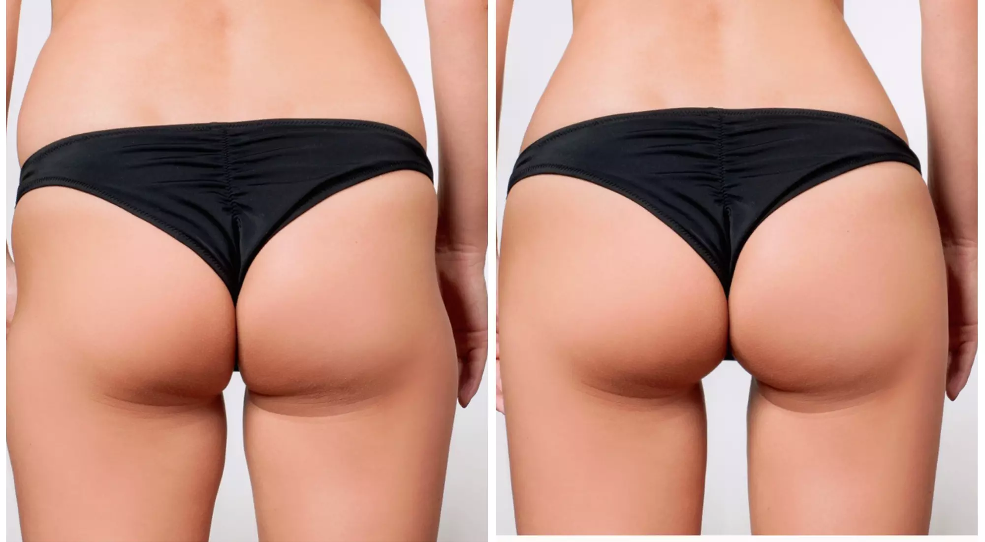 Experience a Brazilian Butt Lift with EMS Technology