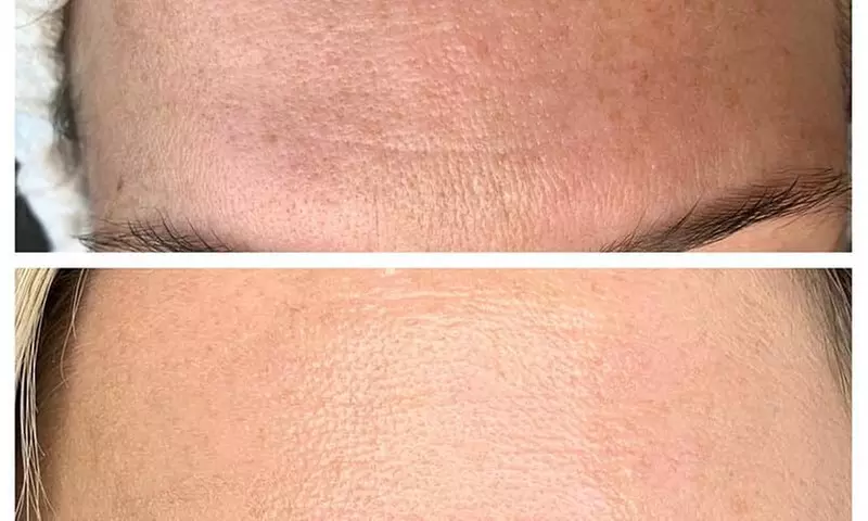 Up to 40% Off on Facial at Luxe Beauty Day Spa & Aesthetics - Second Medium