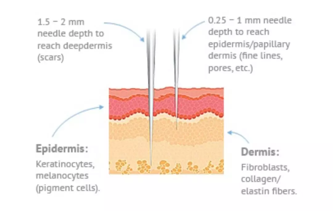 Get a One SkinPen® Precision Micro-needling Treatment for Glowing Skin