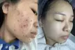 Up to 60% Off on HydraFacial at Magic Beauty Wellness - Second Medium