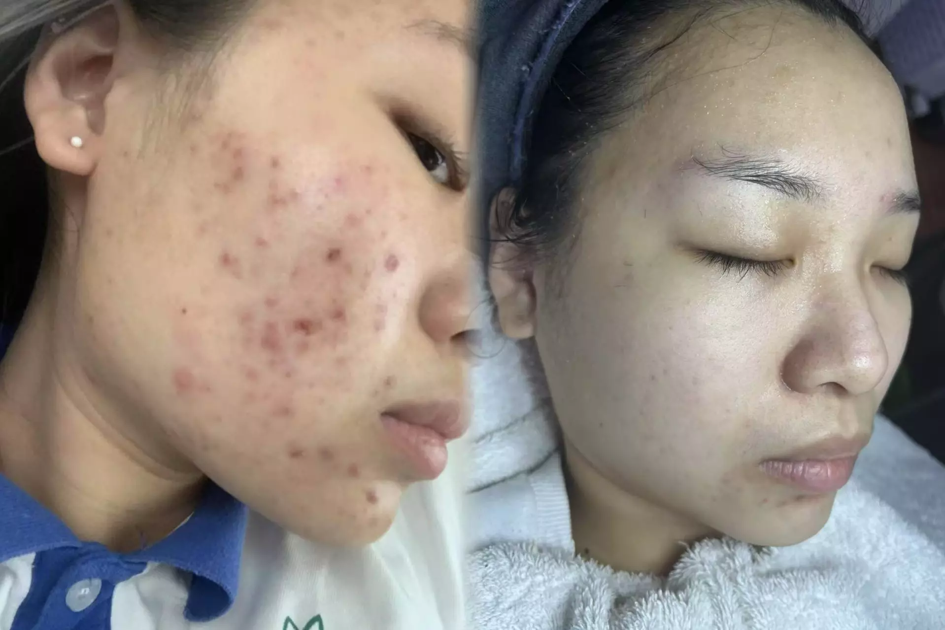 Up to 60% Off on HydraFacial at Magic Beauty Wellness