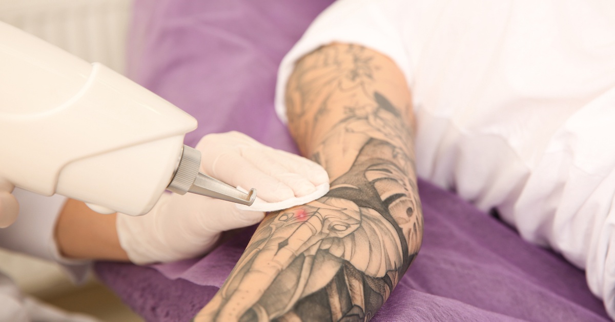 Effective Laser Tattoo Removal Sessions for Various Sizes