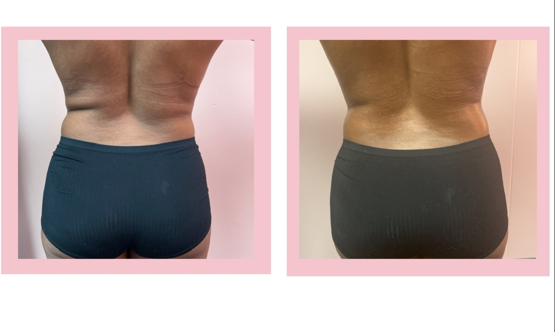 Transform with non-invasive laser lipo treatments