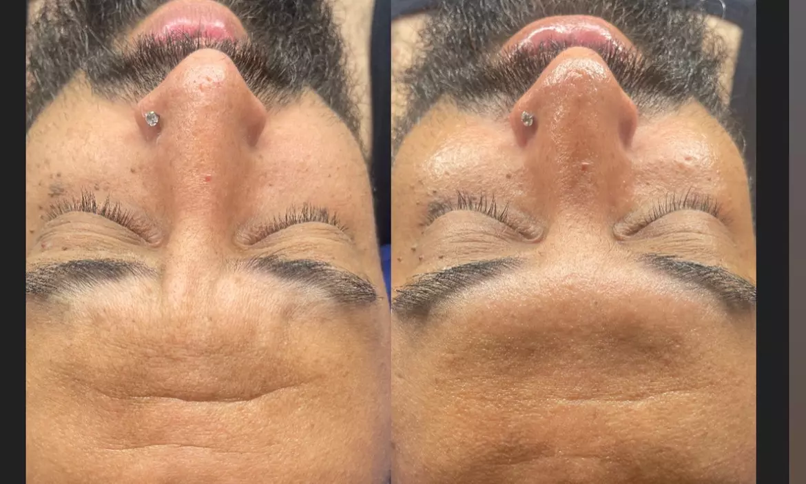 Rejuvenate Your Skin with Microdermabrasion and Facial Options