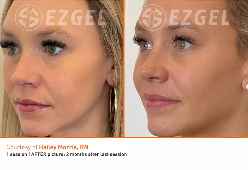 Up to 47% Off on Injection - Plasma at Total Body Aesthetics - Second Medium