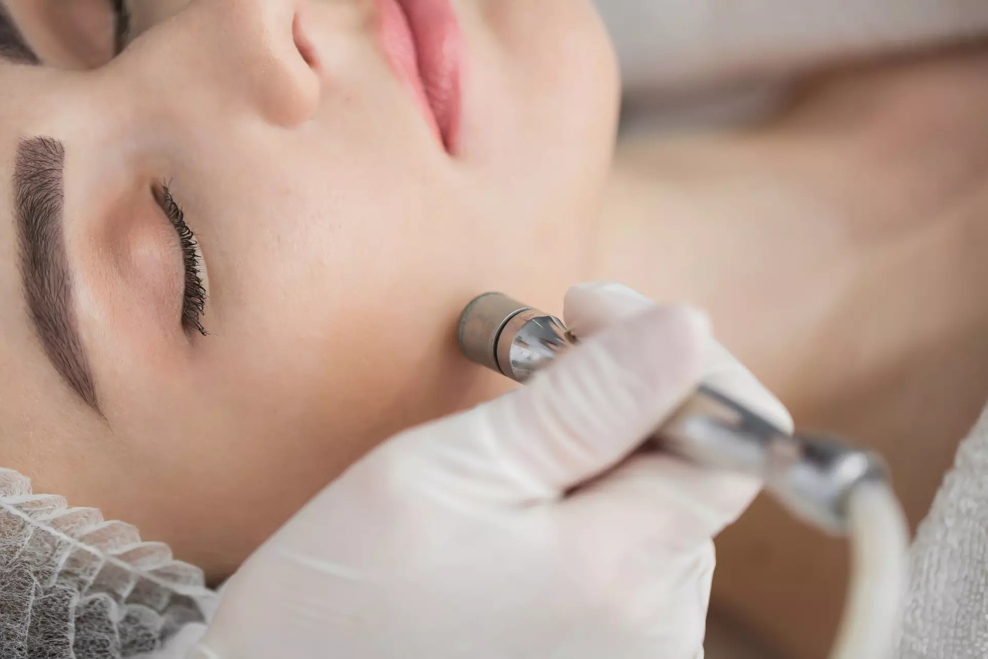 Revitalize with Ireal Aesthetics' Microdermabrasion Facial, enjoy glowing skin up to 42% off - Primary Image