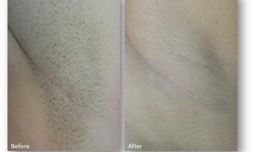 Image 6: Up to 63% Off on Laser Hair Removal at New Moon Aesthetics