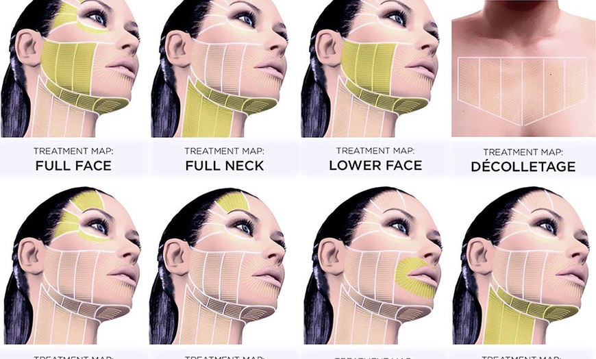Image 4: Up to 79% Off on Facelift - Thread Lift at Turkish Royal Aesthetic