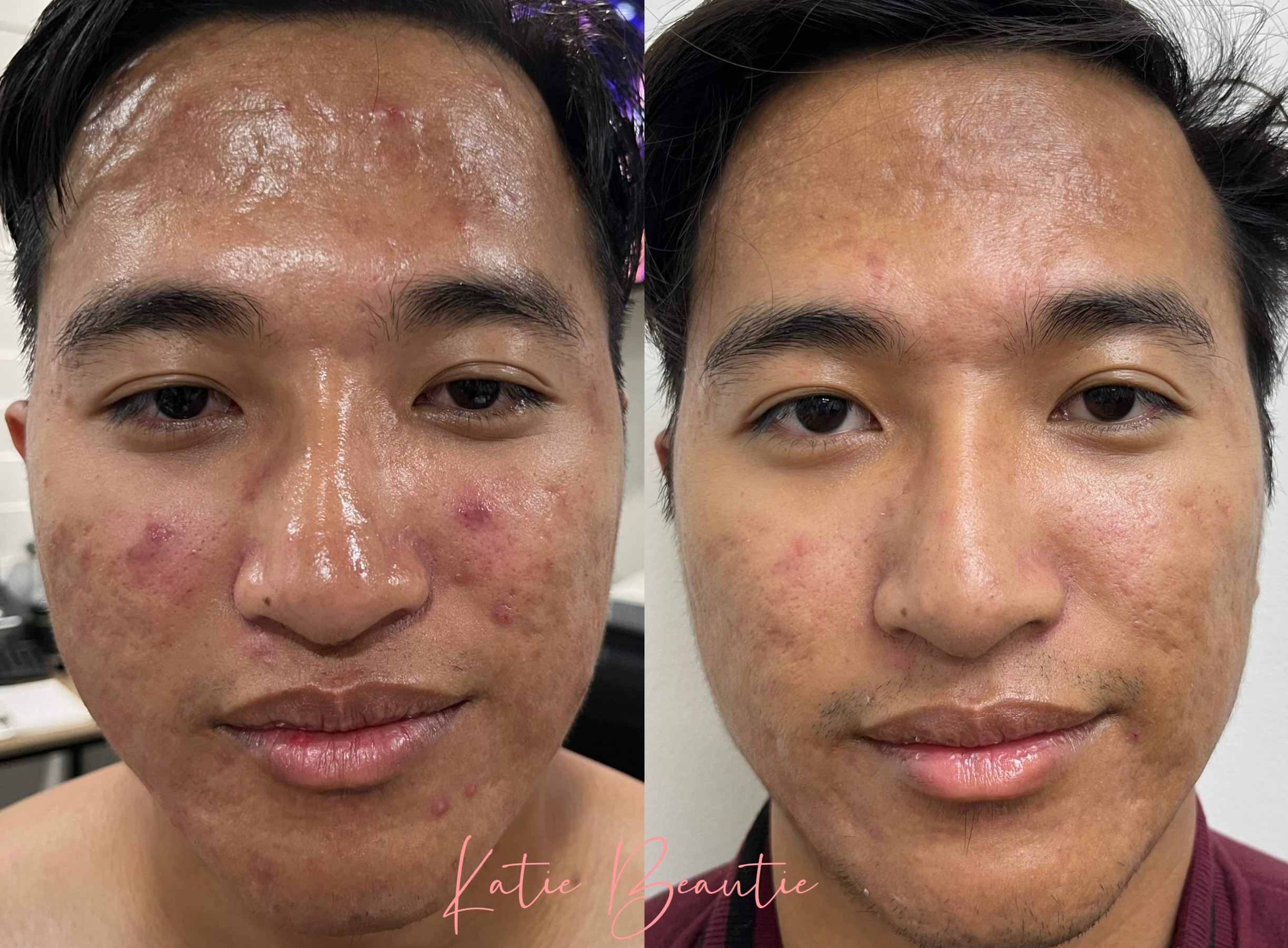 Korean Inflacure Healing Acne Facial, Beyond  Facial, Back Facial, & More at Katie Beautie (Up to 30% Off) - Second Medium