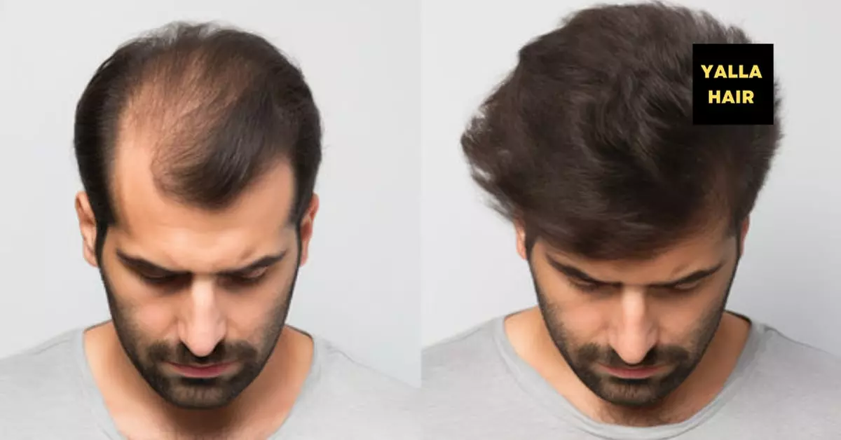 Up to 50% Off on Men's Hair Patch or Hair extensions Fixing