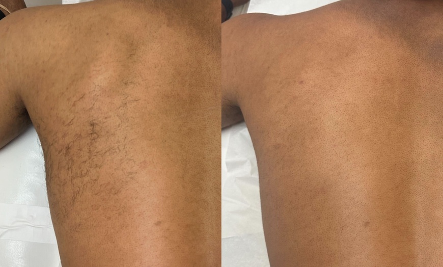 Image 2: Up to 50% Off on Laser Hair Removal at Laser By Nicole Boca Raton