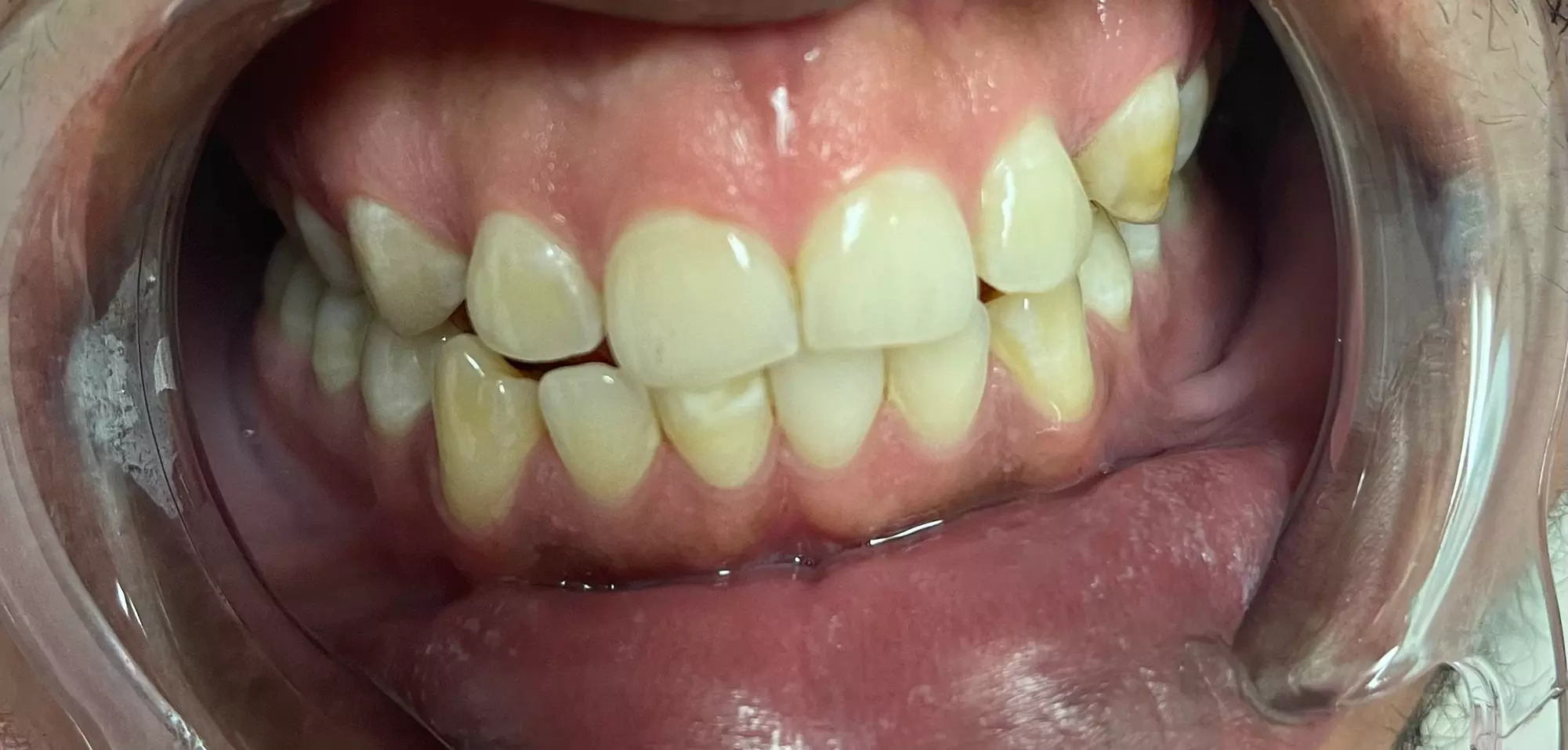 Experience up to 70% off with Wite & Brite Teeth Whitening's One Hour Treatments - Second Medium