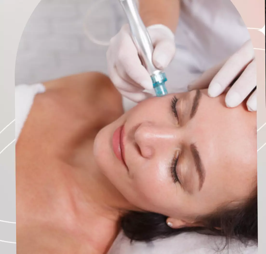 Up to 44% Off on Microdermabrasion at Sara Aesthetics LLC - Primary Image