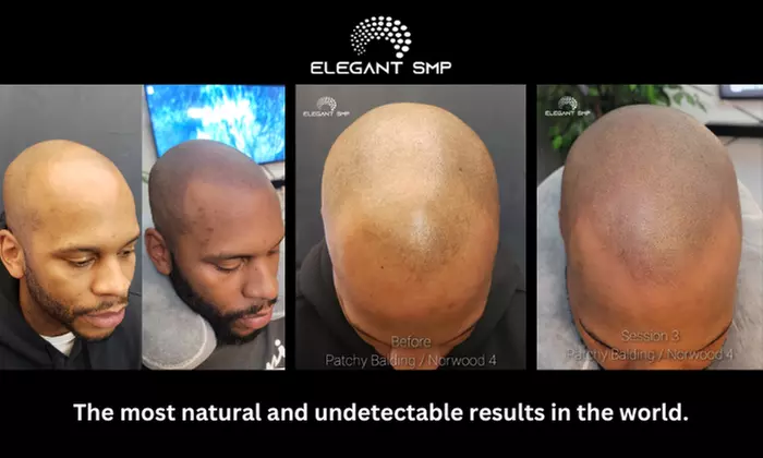 Up to 30% Off on Scalp Care at Elegant Scalp Micropigmentation - Second Medium