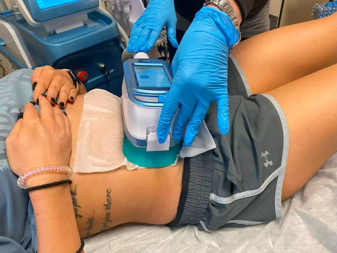 Up to 43% Off on Cryolipolysis at Refined Physique - Primary Image
