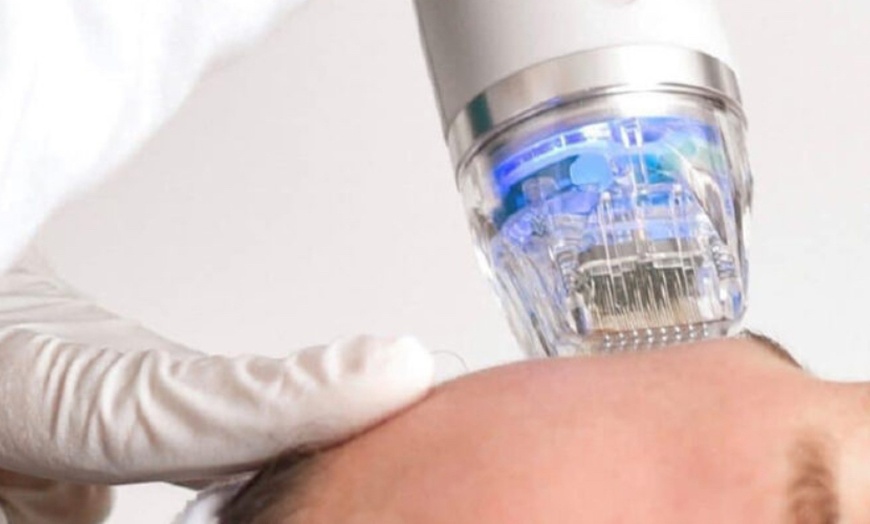 Image 1: Discover the Micro-Needling RF Experience at Dermanova Spa And Salon with up to 56% off, including Facial or Phototherapy