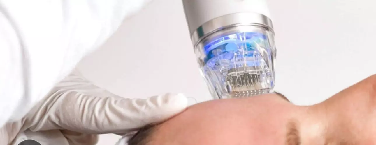 Discover the Micro-Needling RF Experience at Dermanova Spa And Salon with up to 56% off, including Facial or Phototherapy - Primary Image