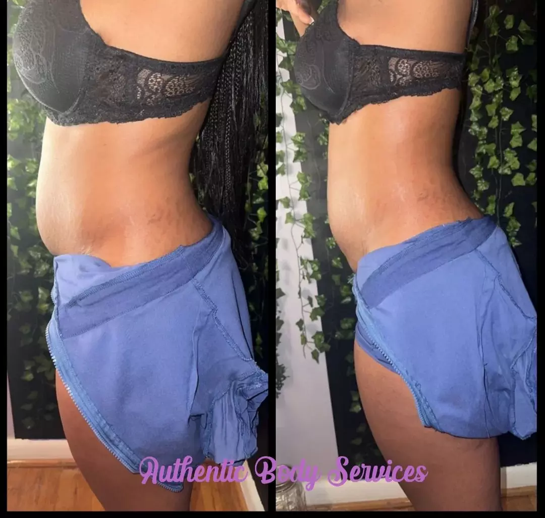 Explore Non Invasive Laser Lipo, RF Skin Tightening & Sauna Detox